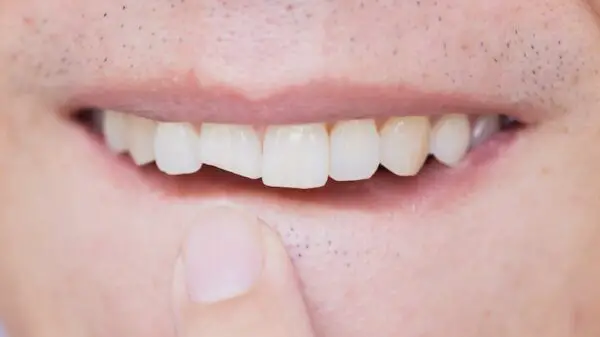 Dental Bonding for Tooth Crack