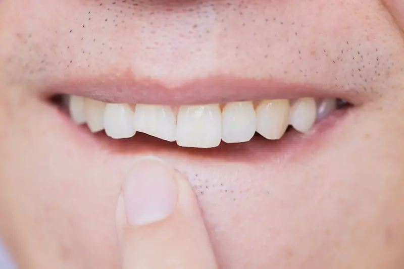 Dental Bonding for Tooth Crack