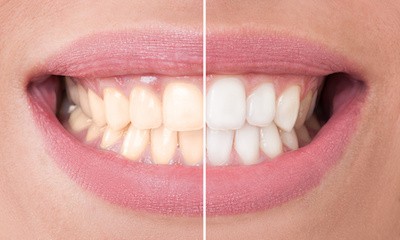 Whitening Porcelain Veneers