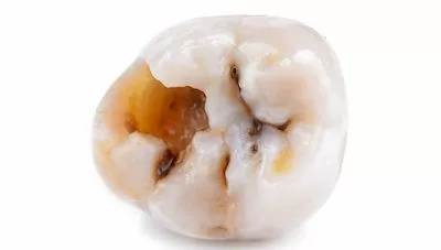 tooth decay