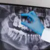 can I exercise after a root canal