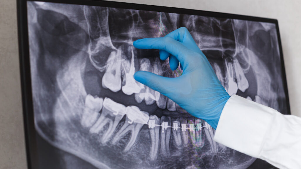 Can I Exercise After Having a Root Canal? Modern Dental Hygiene