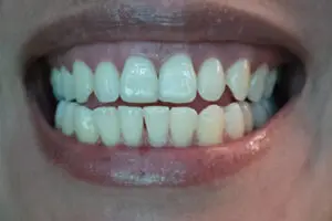 white gums around teeth