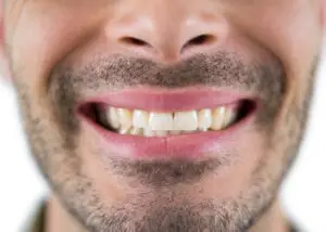Are Yellow Teeth Natural